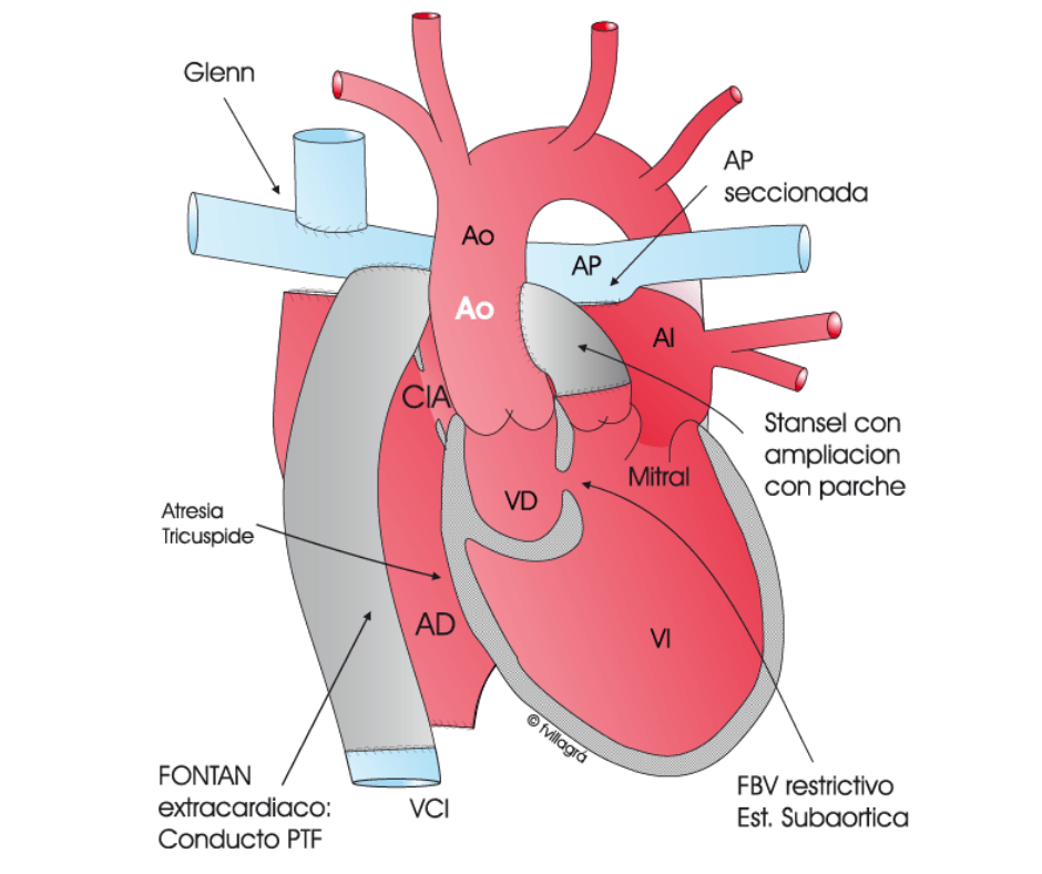 operacion de fontan en cardiopatias congenitas