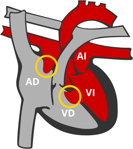 Canal Auriculo ventricular AV