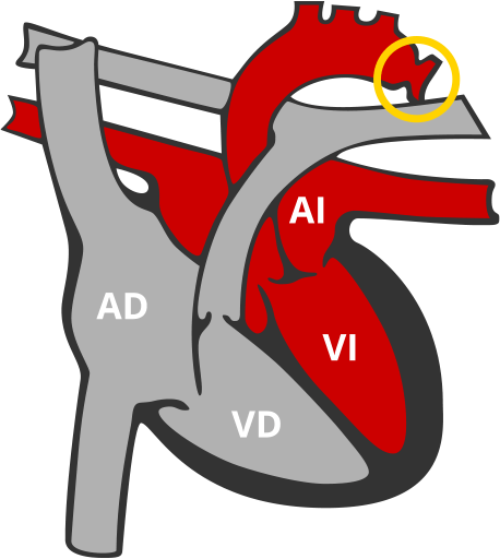 Coartacion de Aorta CoA