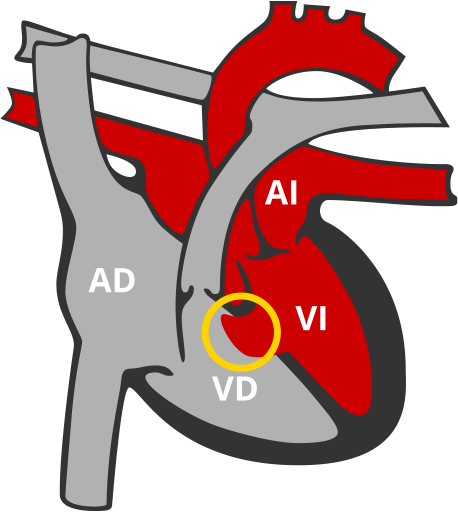 Comunicacion Interventricular CIV