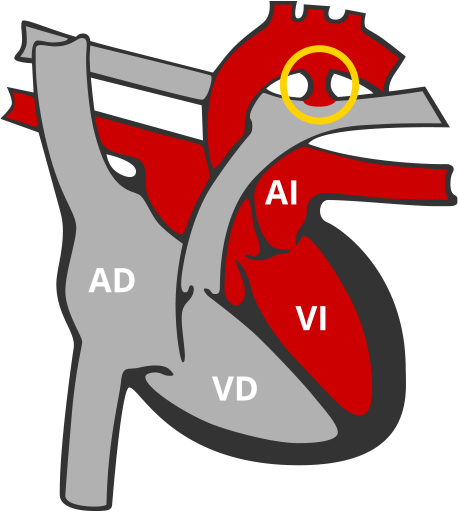 Ductus Arterioso Persistente DAP