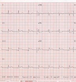 Electrocardiograma