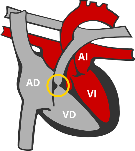 Estenosis pulmonar EP