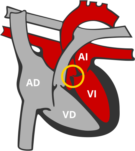 Miocardiopatia hipertrofica MCH