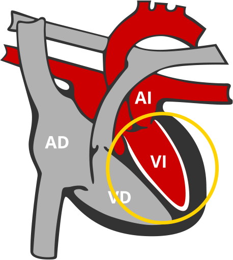 Miocardiopatia restrictiva MCR