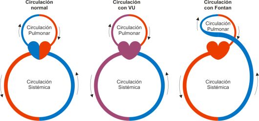 cirugía cardiopatías congénitas