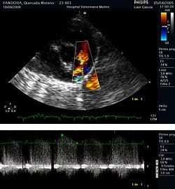 Ecocardiografia Doppler