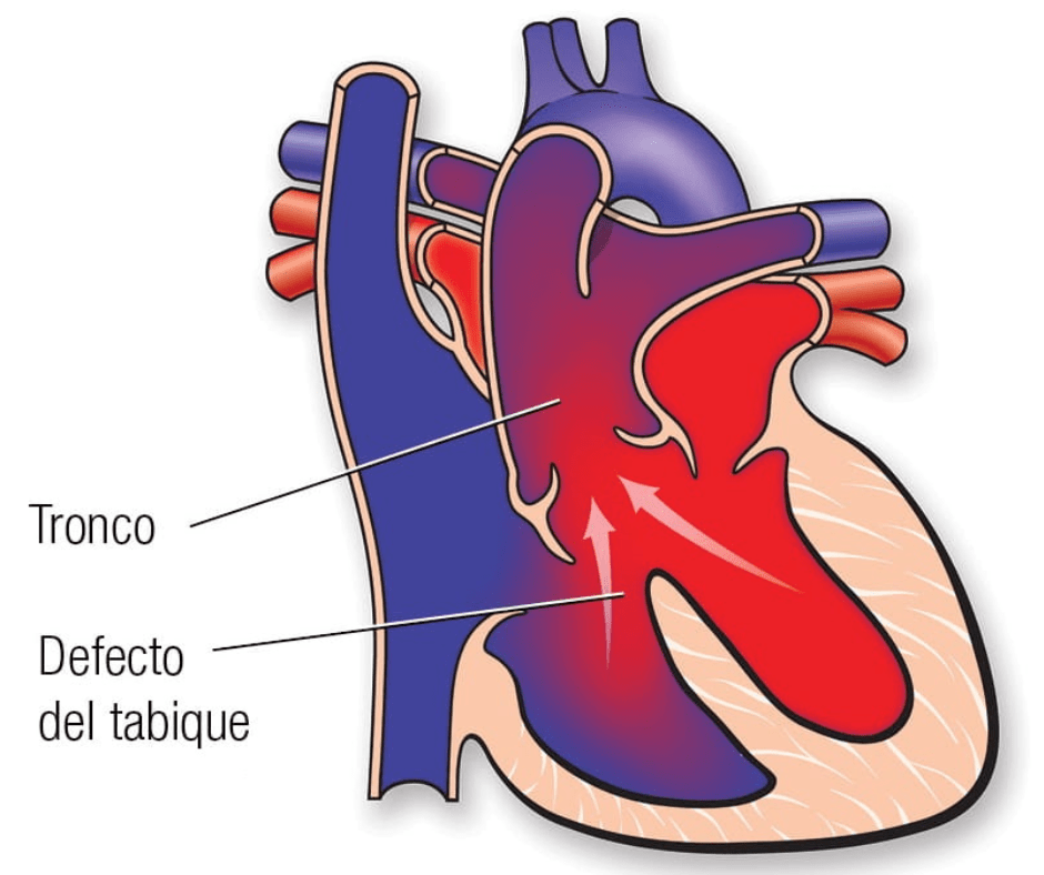 que es el tronco arterial comun