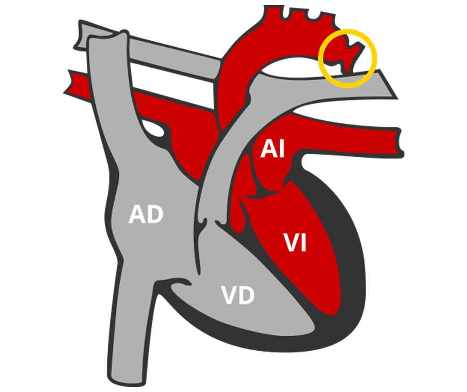 que es la coartacion de aorta