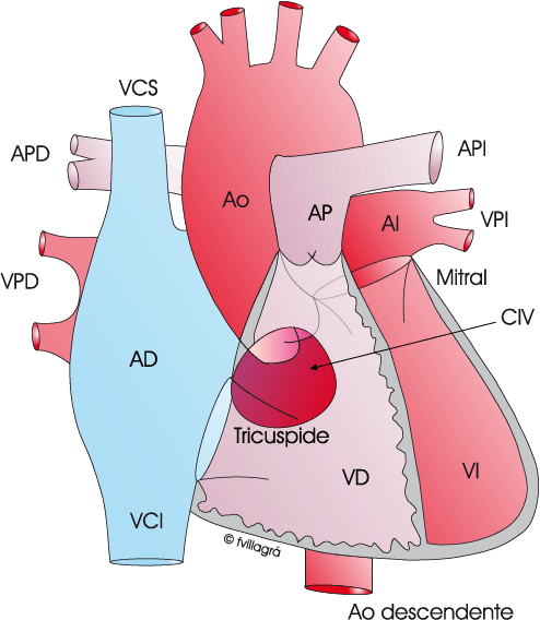 que es la comunincacion intraventricular