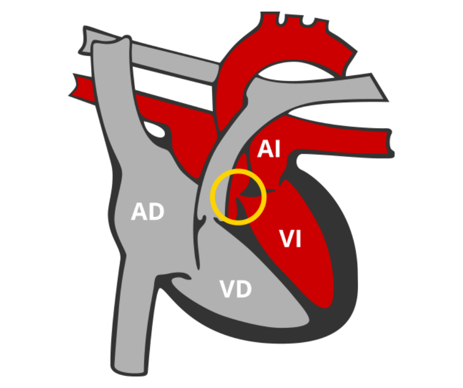 que es la estenosis aortica