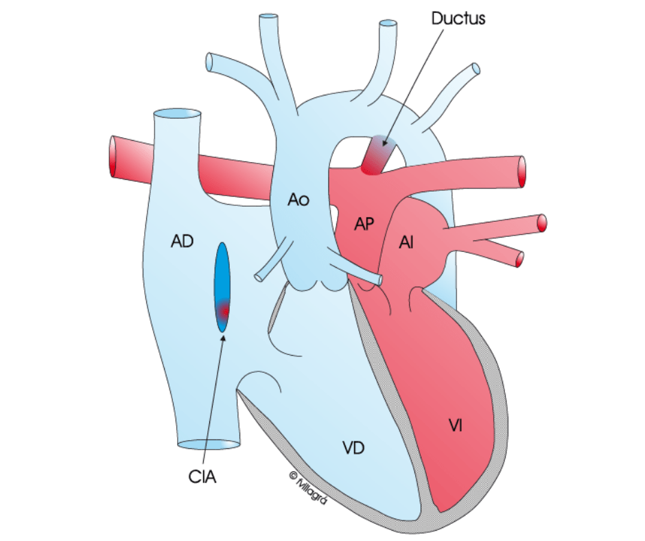 transposicion de grandes arterias