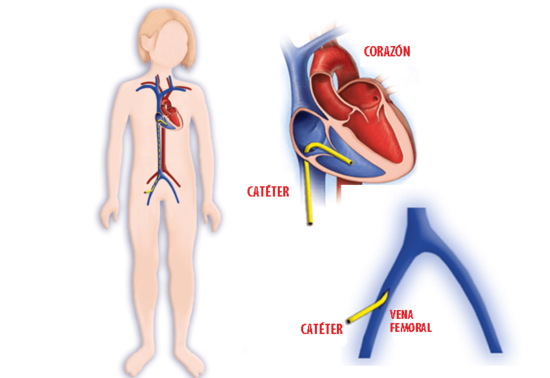 cateterismo cardiaco pediatrico