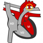 ¿Qué es el ductus arterioso persistente?