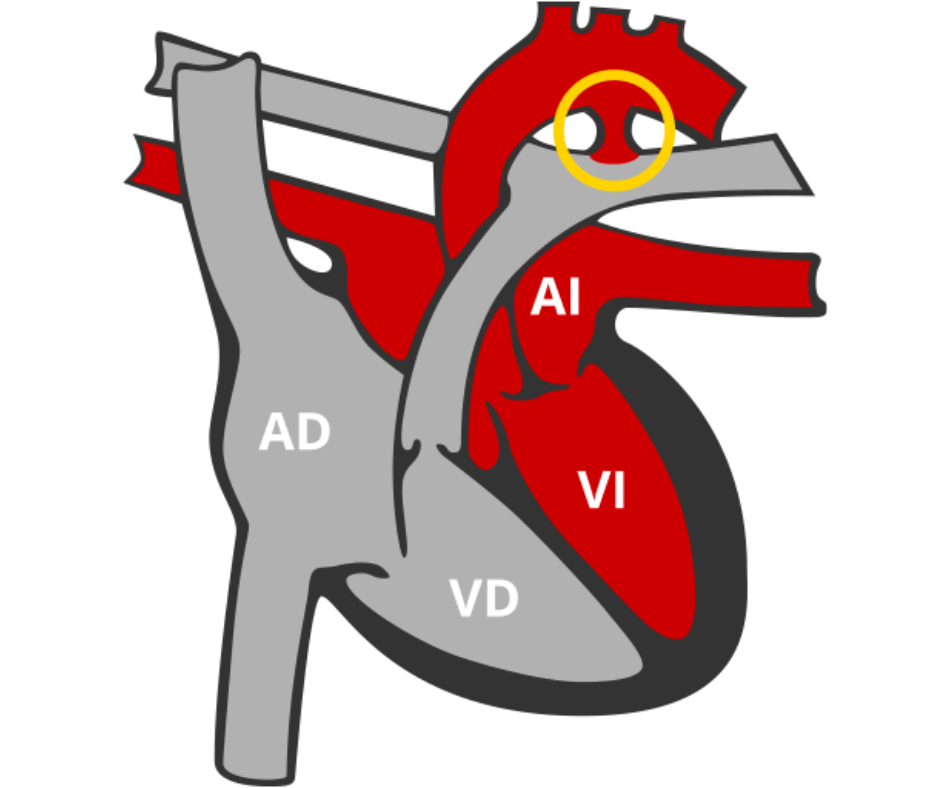 que es el ductus arterioso persistente