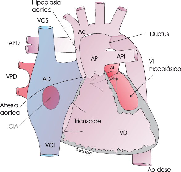 síndrome de hipoplasia del ventrículo izquierdo