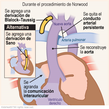 qué es la cirugía de norwood