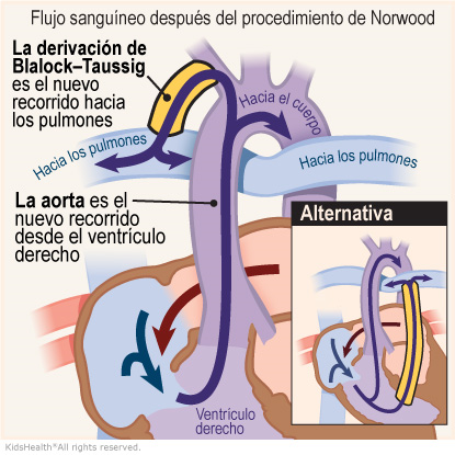 qué ocurre después de la cirugía de norwood