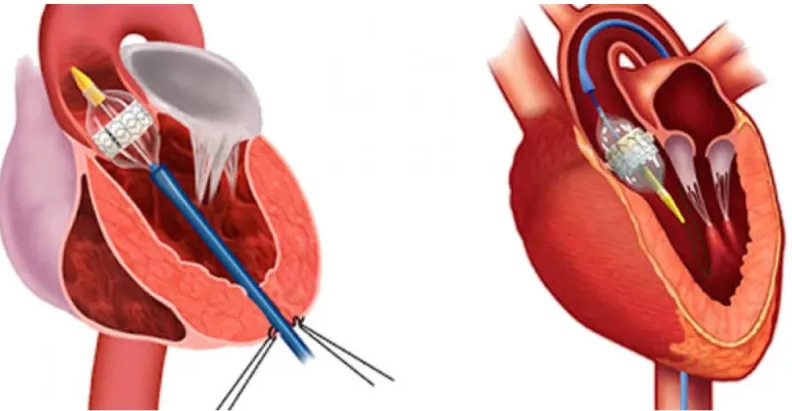 valvuloplastia aórtica